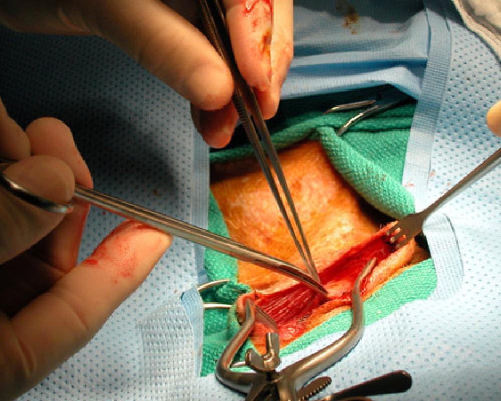 Bypass Surgery to Treat Peripheral Artery Disease What to Expect